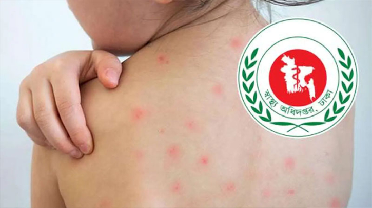 হামের উপসর্গে আরও ৯ জনের মৃত্যু