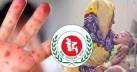হাম উপসর্গে আরও ৫ জনের মৃত্যু