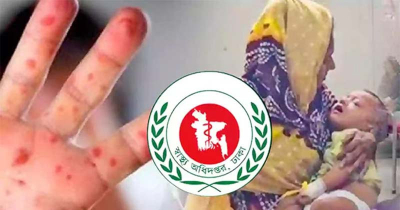 হাম উপসর্গে আরও ৫ জনের মৃত্যু