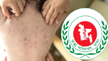 হাম উপসর্গে আরও ৩ মৃত্যু